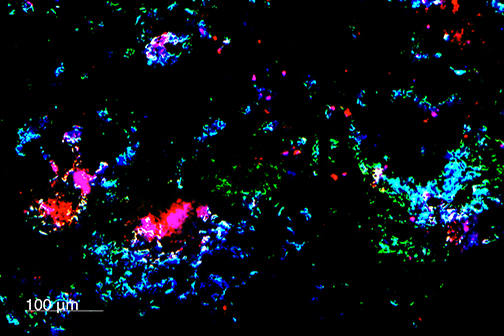 triple-negative breast cancer cells